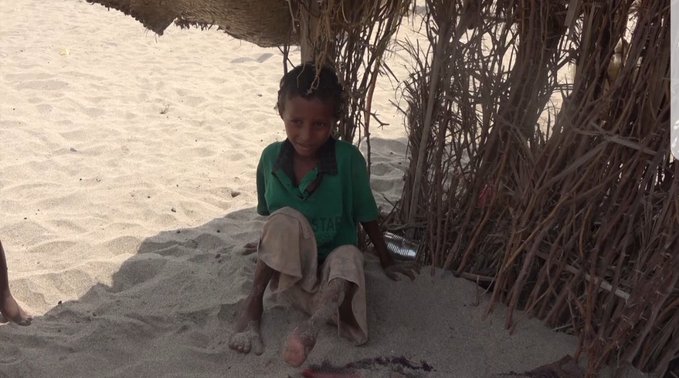 قصة مأساة: قذائف حوثية تُصيب الطِّفل عبد الله بالإعاقة وتُفقِده والدَيه وشقيقته!