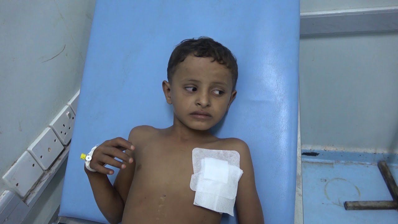 إصابة طفلين أحدهم حالته خطيرة بقصف للحوثيين في الحديدة